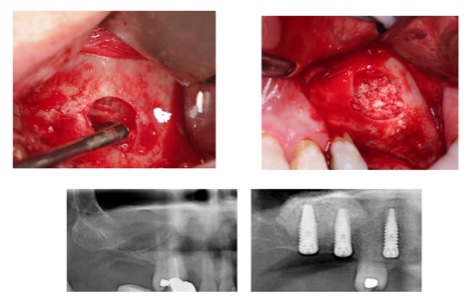 Sinus Lift Module