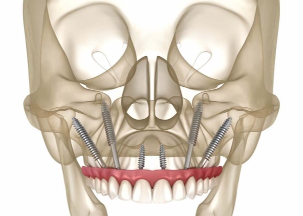 Full Arch Rehabilitation and Digital Workflow